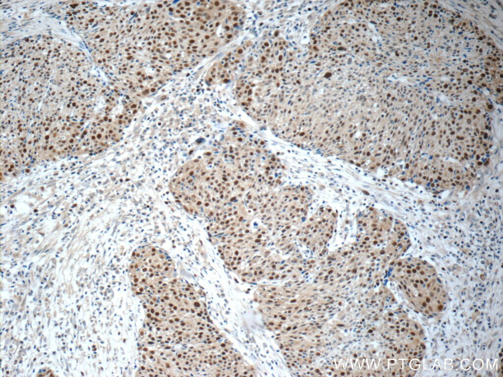 Immunohistochemistry (IHC) staining of human lung cancer tissue using MCM7 Polyclonal antibody (11225-1-AP)