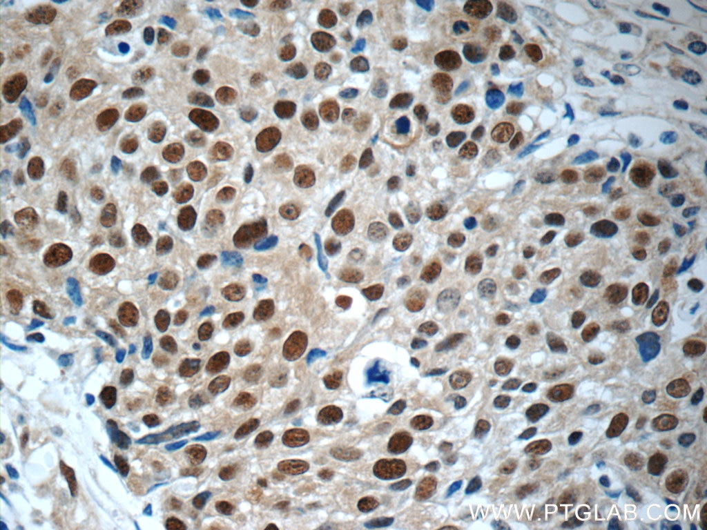 IHC staining of human lung cancer using 11225-1-AP