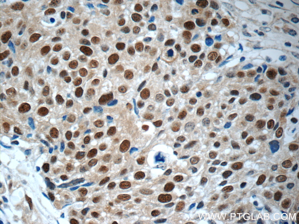 Immunohistochemistry (IHC) staining of human lung cancer tissue using MCM7 Polyclonal antibody (11225-1-AP)