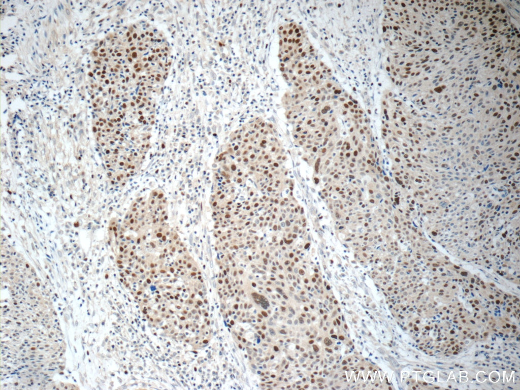 IHC staining of human lung cancer using 11225-1-AP