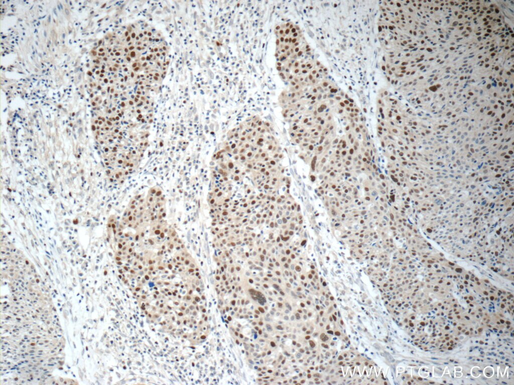 Immunohistochemistry (IHC) staining of human lung cancer tissue using MCM7 Polyclonal antibody (11225-1-AP)