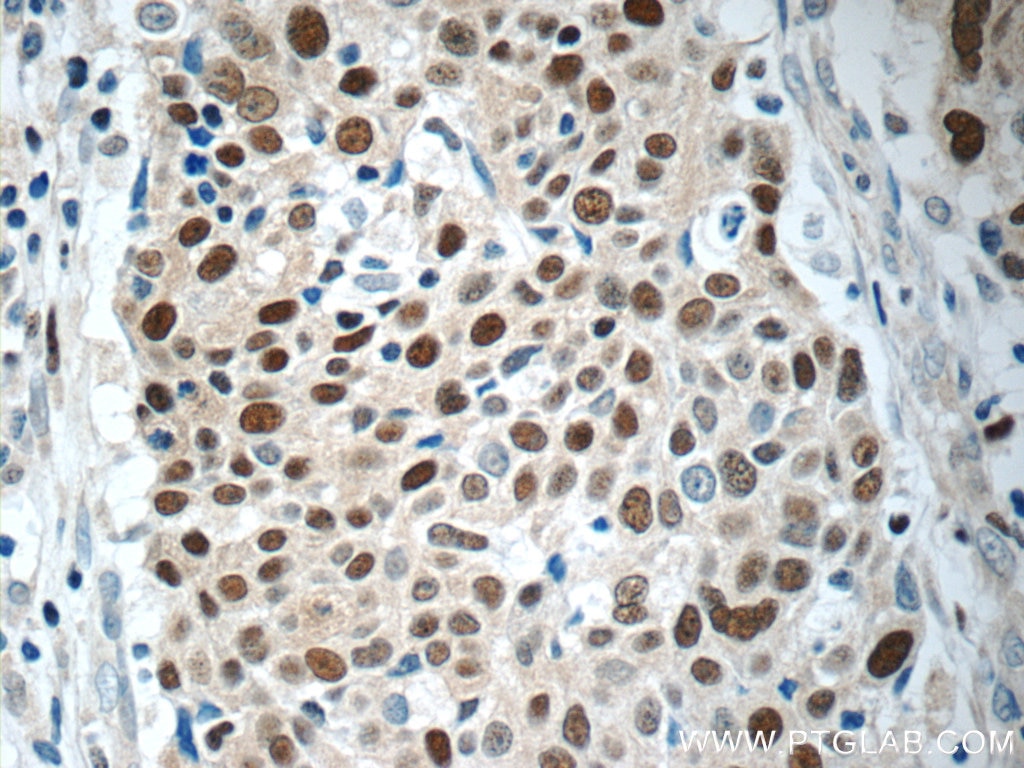 Immunohistochemistry (IHC) staining of human lung cancer tissue using MCM7 Polyclonal antibody (11225-1-AP)