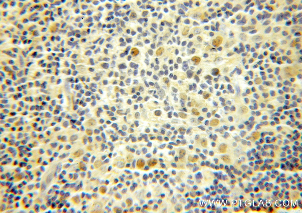 Immunohistochemistry (IHC) staining of human lymphoma tissue using MCM7 Polyclonal antibody (11225-1-AP)