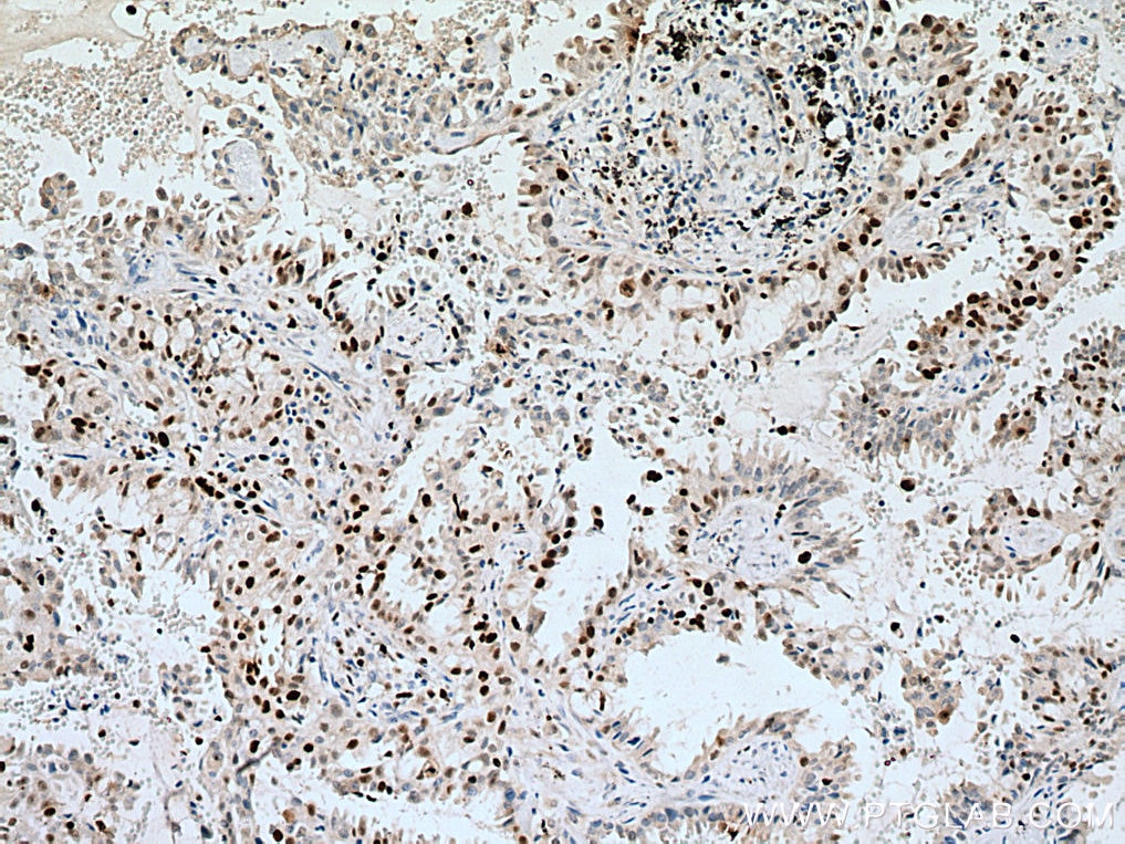 Immunohistochemistry (IHC) staining of human lung cancer tissue using MCM7 Monoclonal antibody (67446-1-Ig)