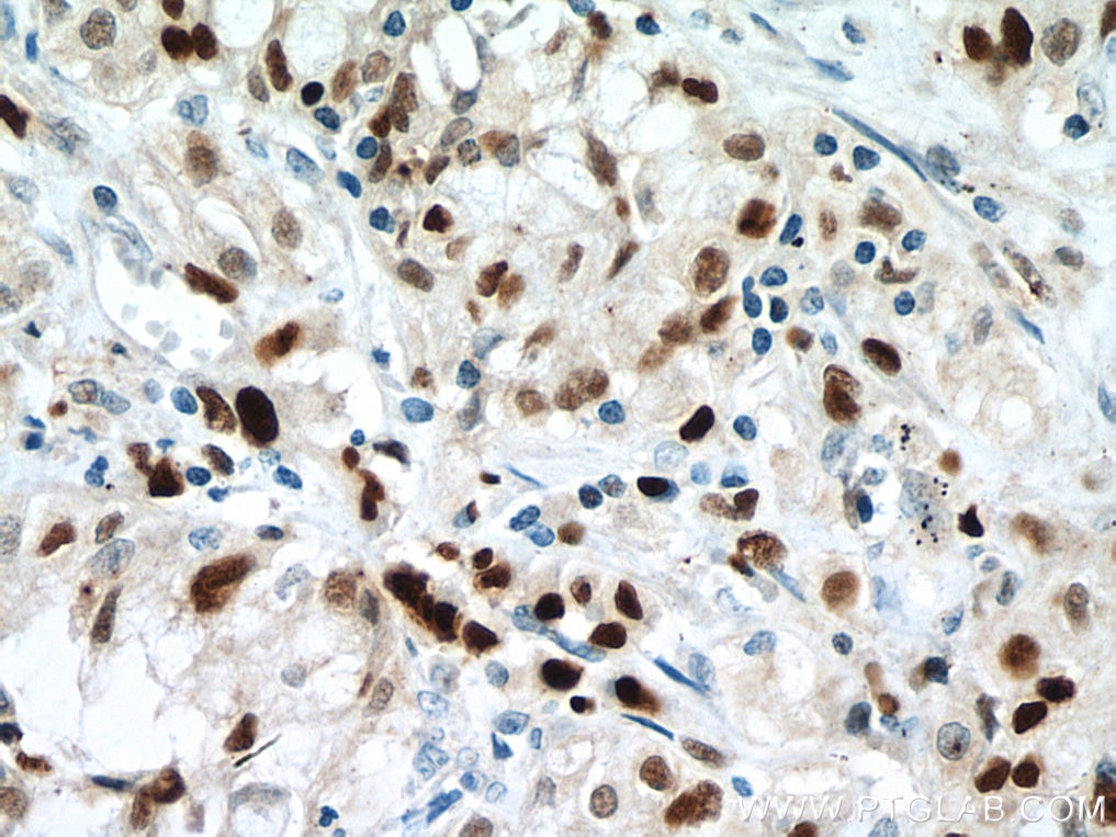 Immunohistochemistry (IHC) staining of human lung cancer tissue using MCM7 Monoclonal antibody (67446-1-Ig)