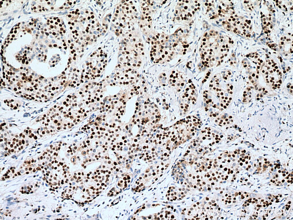 Immunohistochemistry (IHC) staining of human breast cancer tissue using MCM7 Monoclonal antibody (67446-1-Ig)