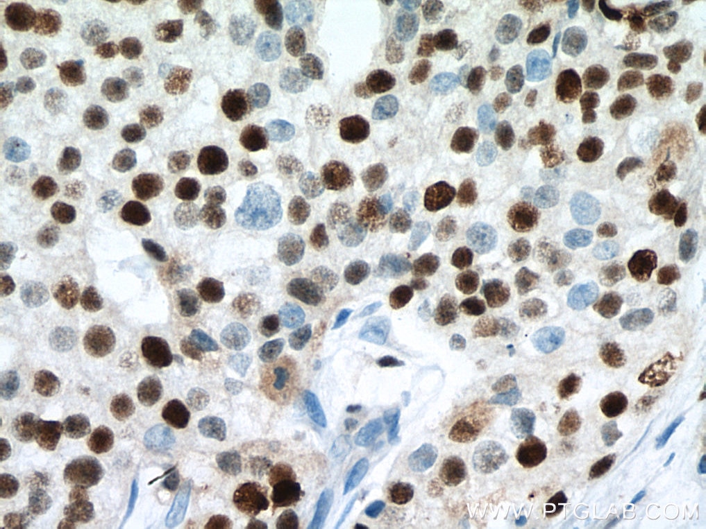 Immunohistochemistry (IHC) staining of human breast cancer tissue using MCM7 Monoclonal antibody (67446-1-Ig)
