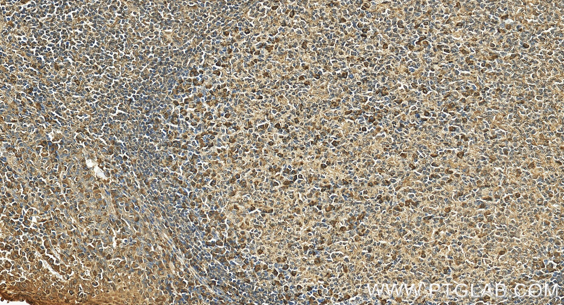 Immunohistochemical analysis of paraffin-embedded human tonsillitis tissue slide using 86202-1-RR (MCOLN3 antibody) at dilution of 1:1000 (under 20x lens). Heat mediated antigen retrieval with Tris-EDTA buffer (pH 9.0). Immunohistochemistry (IHC) staining of human tonsillitis tissue using MCOLN3 Recombinant monoclonal antibody (86202-1-RR)