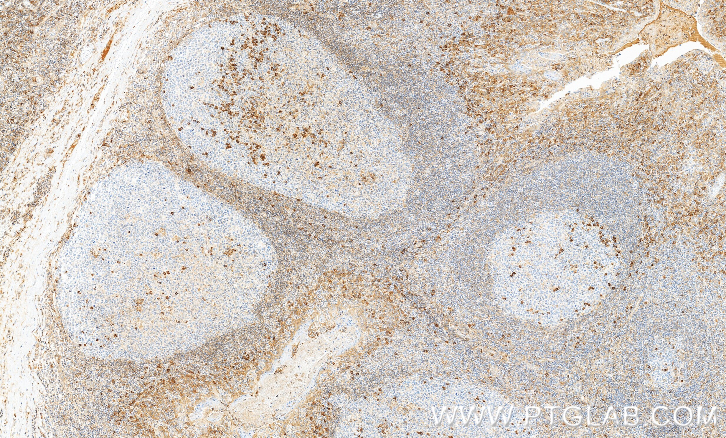 Immunohistochemistry (IHC) staining of human tonsillitis tissue using MCOLN3 Recombinant monoclonal antibody (86202-1-RR)