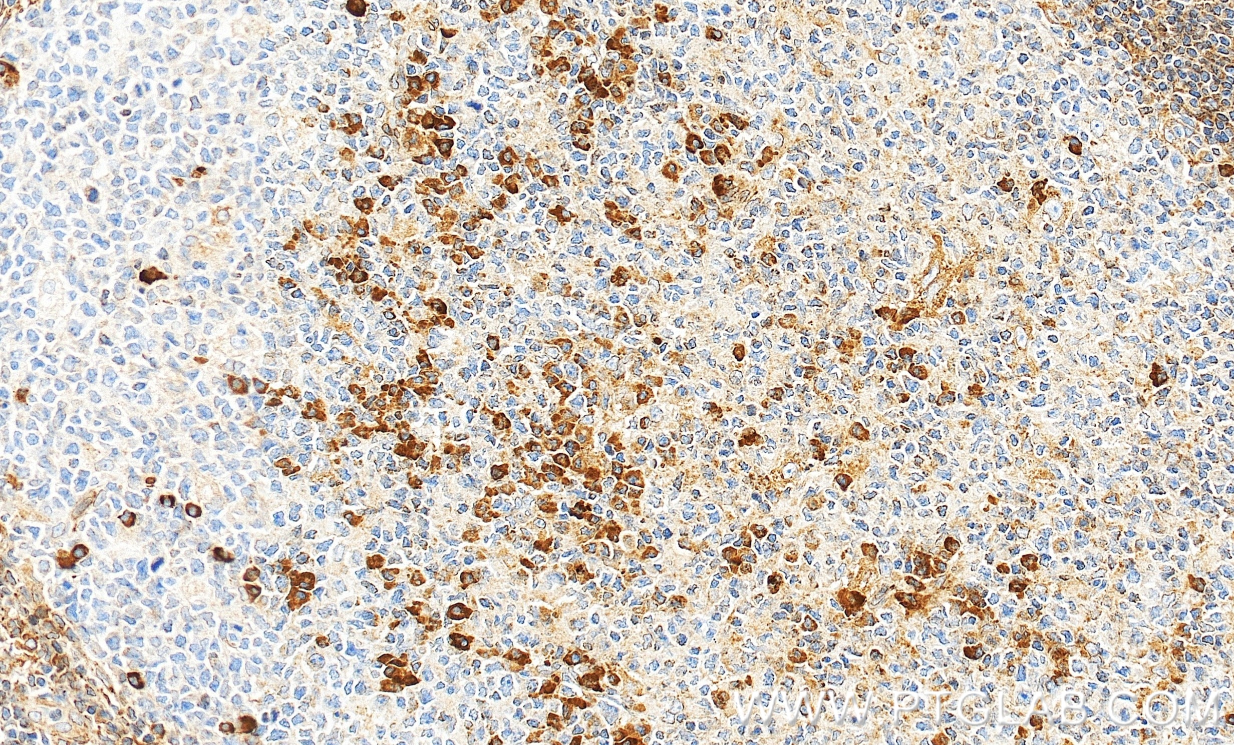 Immunohistochemistry (IHC) staining of human tonsillitis tissue using MCOLN3 Recombinant monoclonal antibody (86202-1-RR)