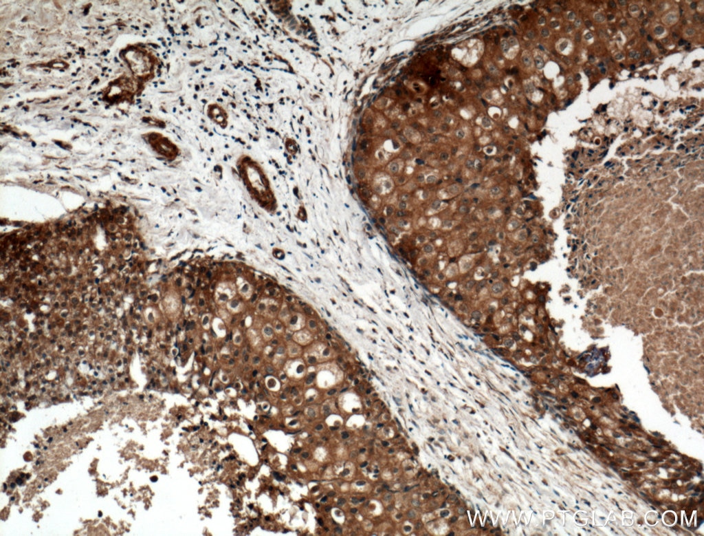 Immunohistochemistry (IHC) staining of human breast cancer tissue using MCP1 Polyclonal antibody (25542-1-AP)