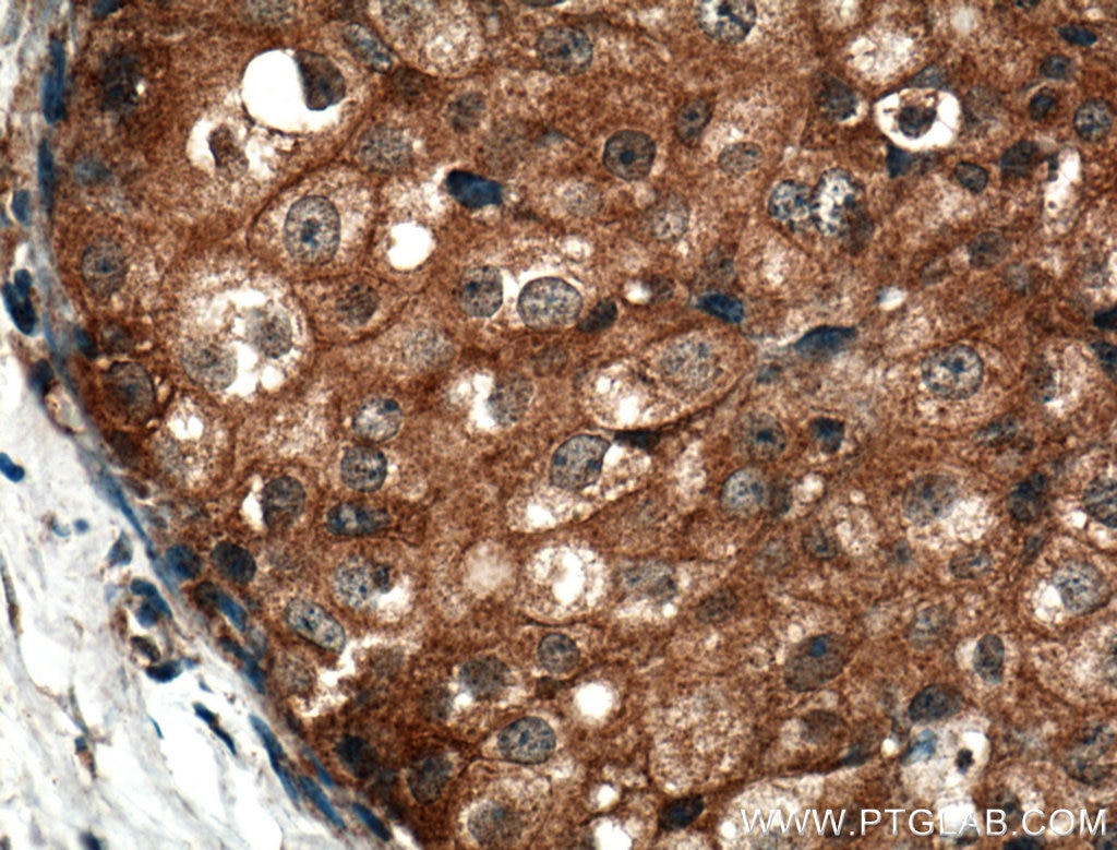 Immunohistochemistry (IHC) staining of human breast cancer tissue using MCP1 Polyclonal antibody (25542-1-AP)