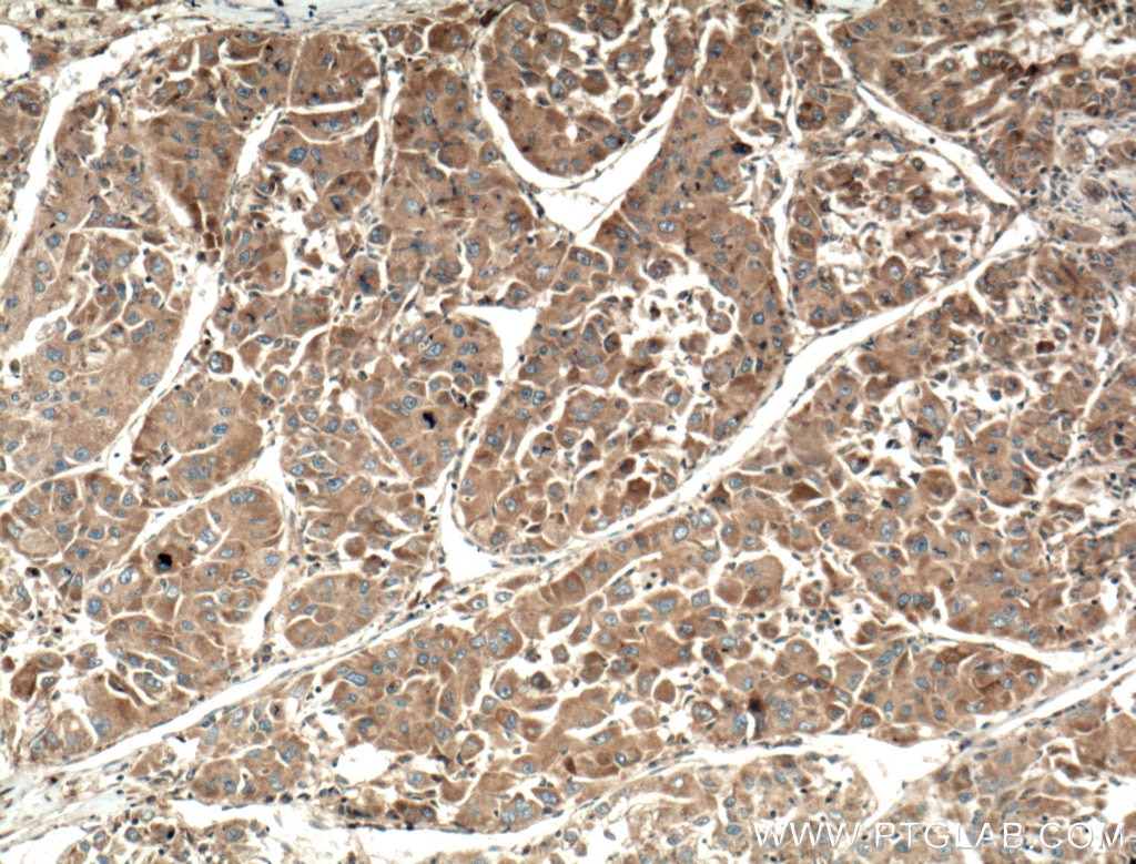 Immunohistochemistry (IHC) staining of human liver cancer tissue using MCP1 Polyclonal antibody (25542-1-AP)