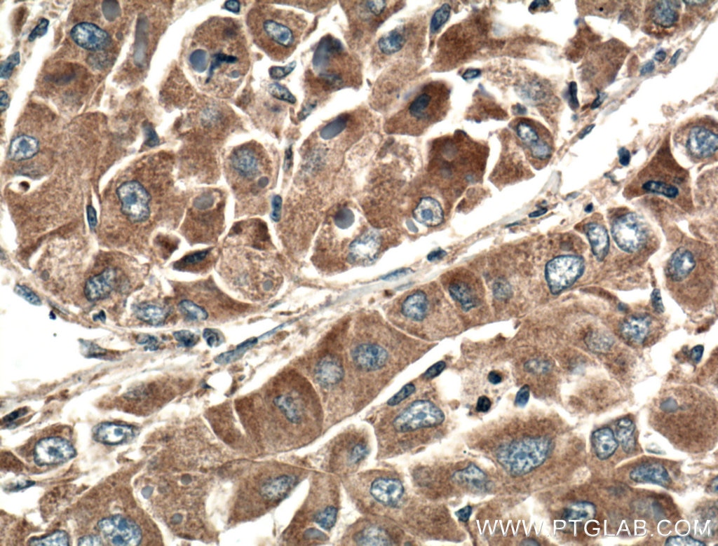 IHC staining of human liver cancer using 25542-1-AP