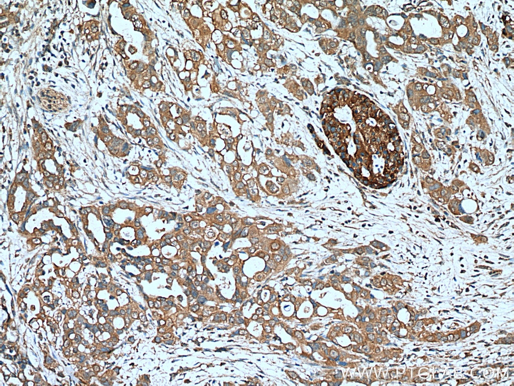 Immunohistochemistry (IHC) staining of human pancreas cancer tissue using MCP1 Polyclonal antibody (25542-1-AP)