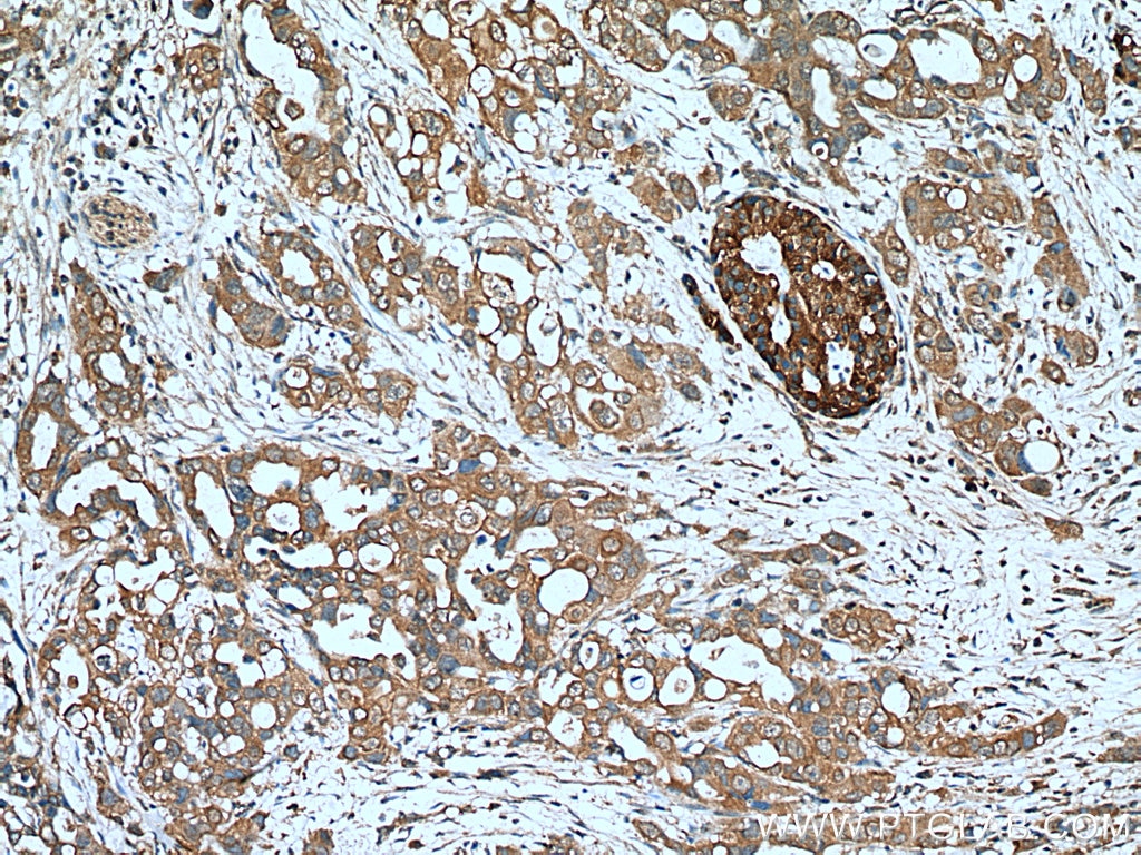 IHC staining of human pancreas cancer using 25542-1-AP