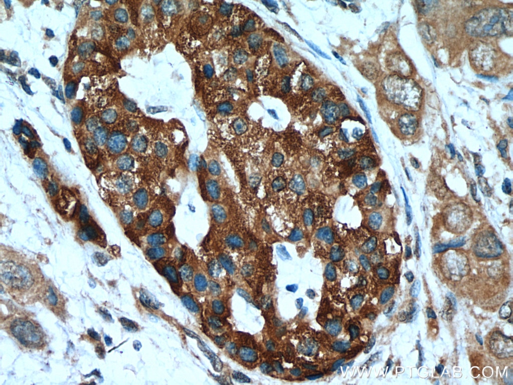 IHC staining of human pancreas cancer using 25542-1-AP