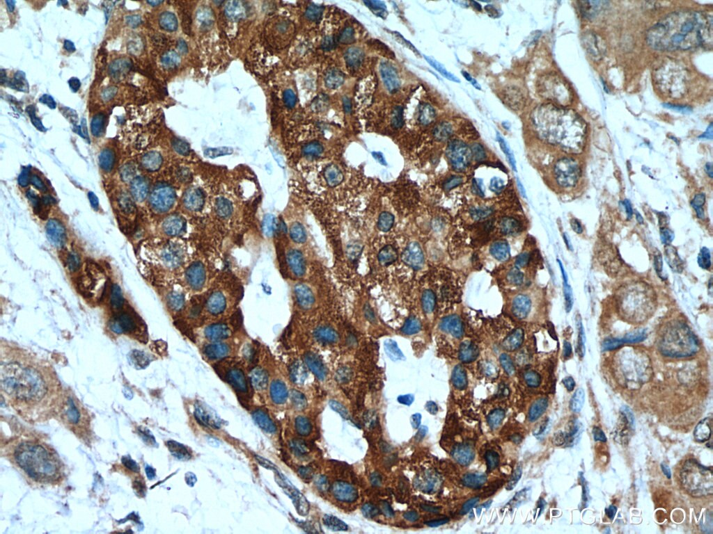 Immunohistochemistry (IHC) staining of human pancreas cancer tissue using MCP1 Polyclonal antibody (25542-1-AP)