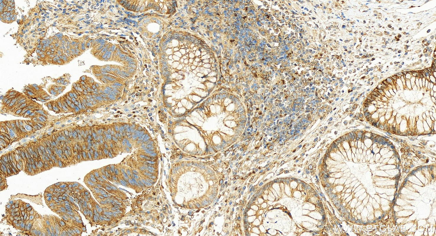 Immunohistochemical analysis of paraffin-embedded human colon cancer tissue slide using 20139-1-AP (MCT1 antibody) at dilution of 1:1600 (under 20x lens). Heat mediated antigen retrieval with Tris-EDTA buffer (pH 9.0). Immunohistochemistry (IHC) staining of human colon cancer tissue using MCT1 Polyclonal antibody (20139-1-AP)