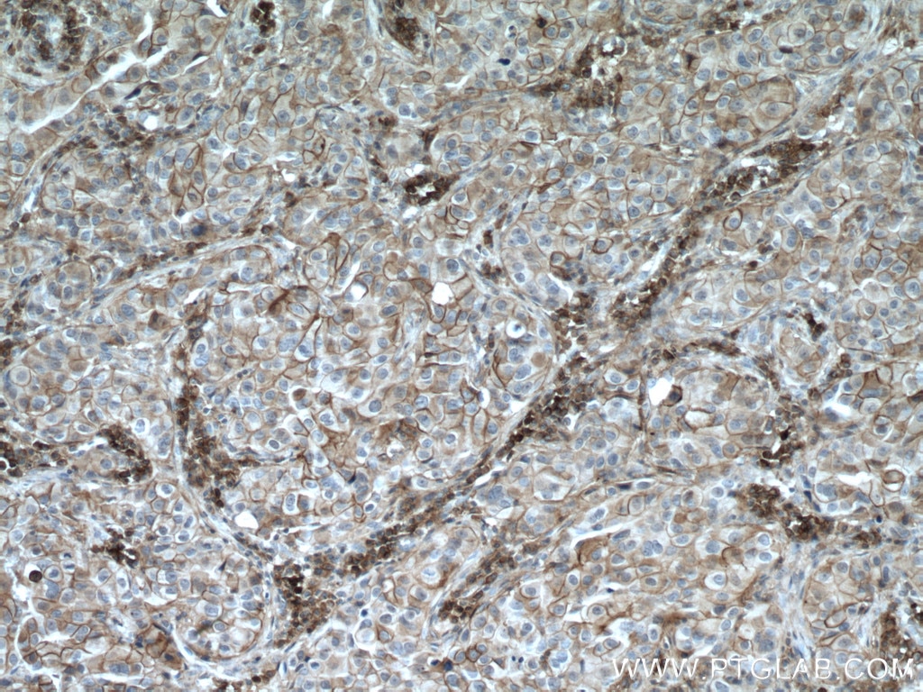 Immunohistochemistry (IHC) staining of human breast cancer tissue using MCT1 Polyclonal antibody (20139-1-AP)