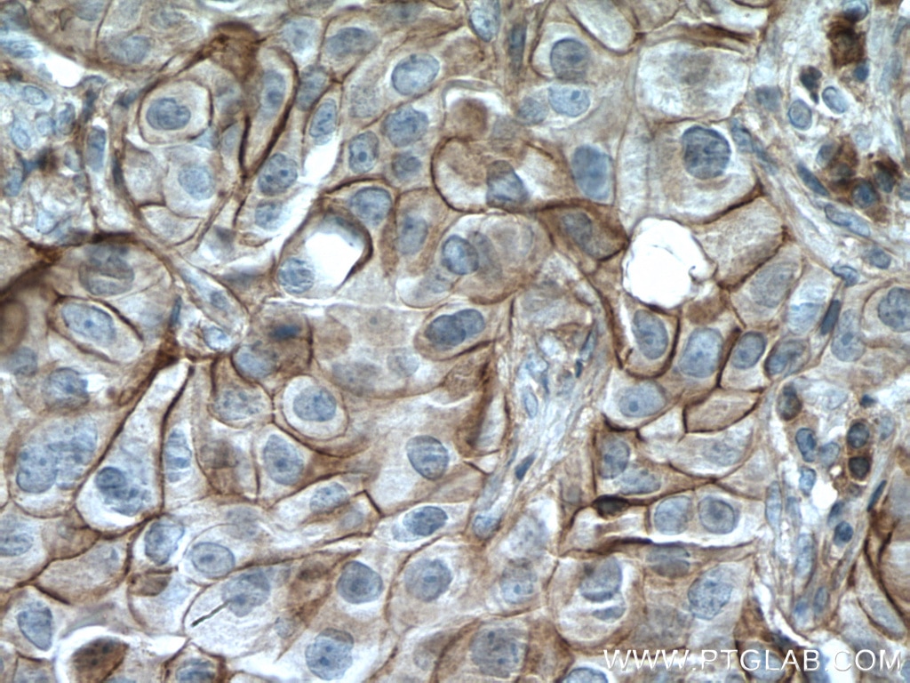 Immunohistochemistry (IHC) staining of human breast cancer tissue using MCT1 Polyclonal antibody (20139-1-AP)