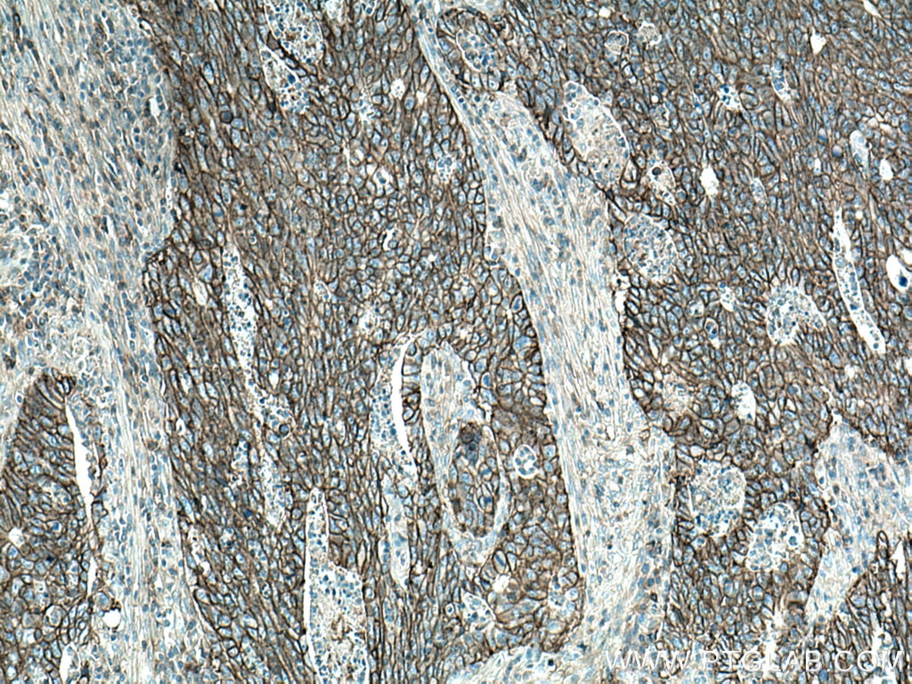 Immunohistochemistry (IHC) staining of human colon cancer tissue using MCT1 Polyclonal antibody (20139-1-AP)