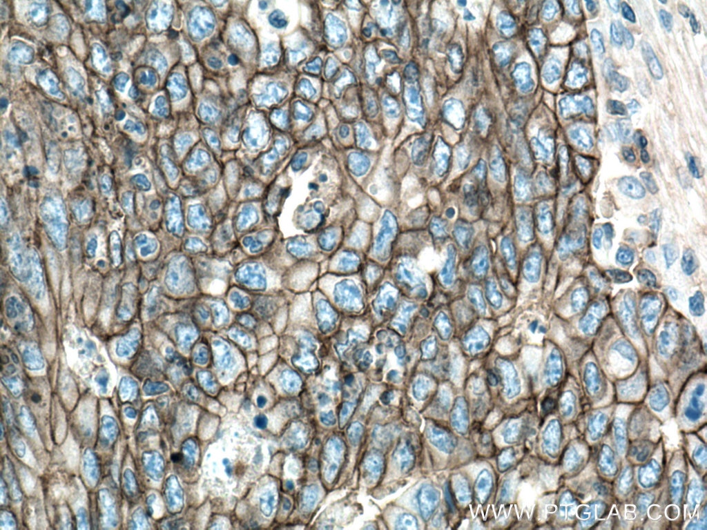 Immunohistochemistry (IHC) staining of human colon cancer tissue using MCT1 Polyclonal antibody (20139-1-AP)