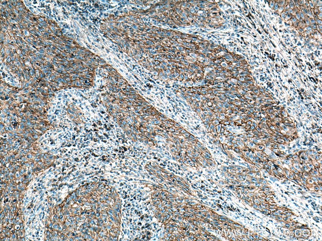 IHC staining of human cervical cancer using 20139-1-AP