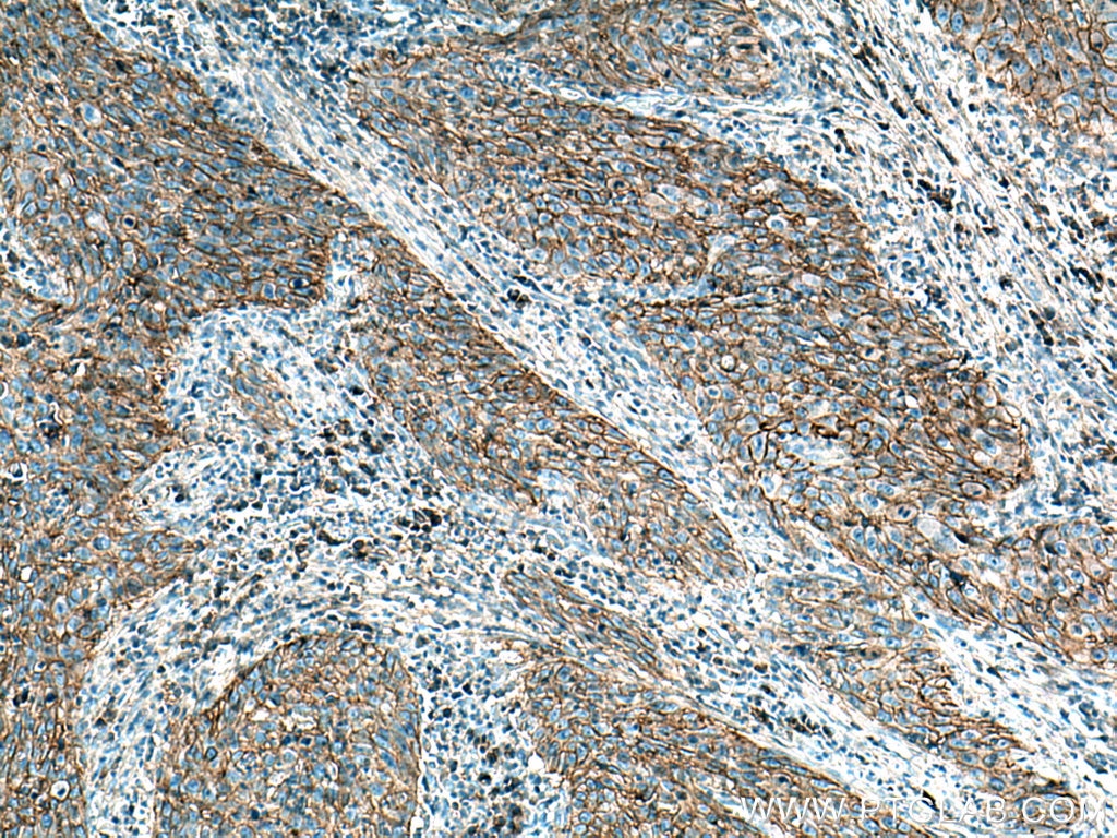 Immunohistochemistry (IHC) staining of human cervical cancer tissue using MCT1 Polyclonal antibody (20139-1-AP)