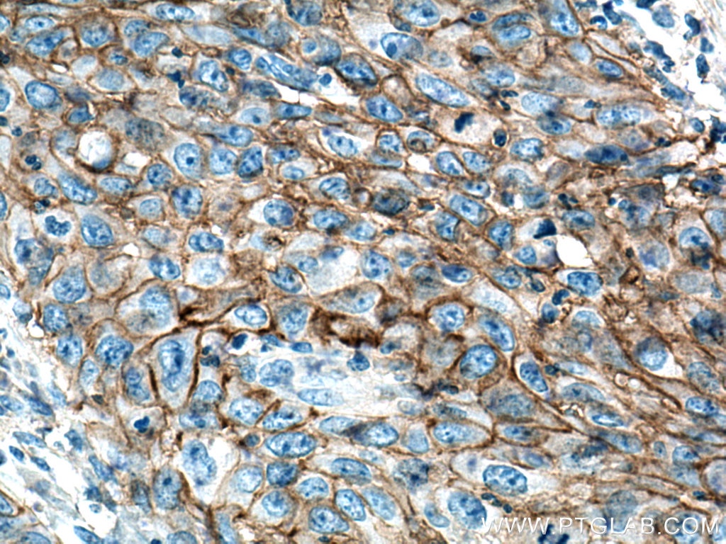 Immunohistochemistry (IHC) staining of human cervical cancer tissue using MCT1 Polyclonal antibody (20139-1-AP)