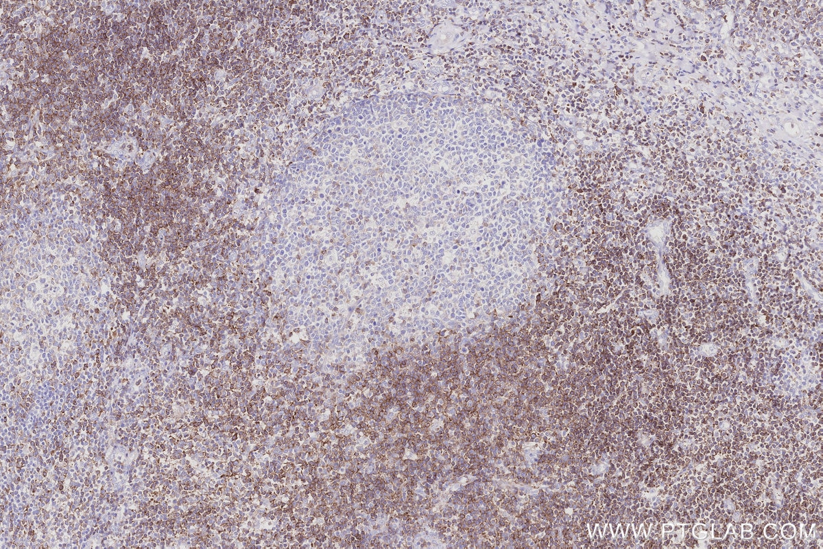 Immunohistochemistry (IHC) staining of human tonsillitis tissue using MCTS1 Recombinant monoclonal antibody (84312-5-RR)