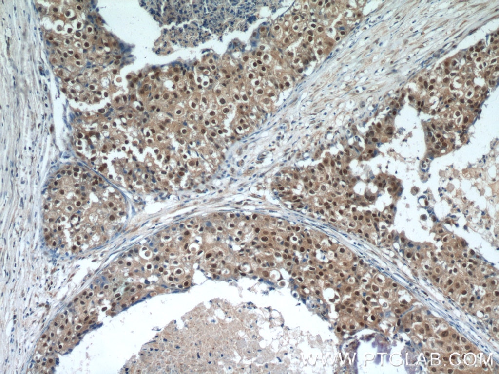 Immunohistochemistry (IHC) staining of human breast cancer tissue using MDC1 Polyclonal antibody (24721-1-AP)