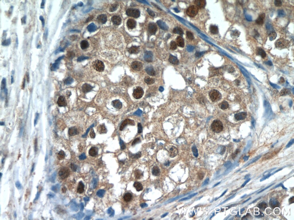 Immunohistochemistry (IHC) staining of human breast cancer tissue using MDC1 Polyclonal antibody (24721-1-AP)