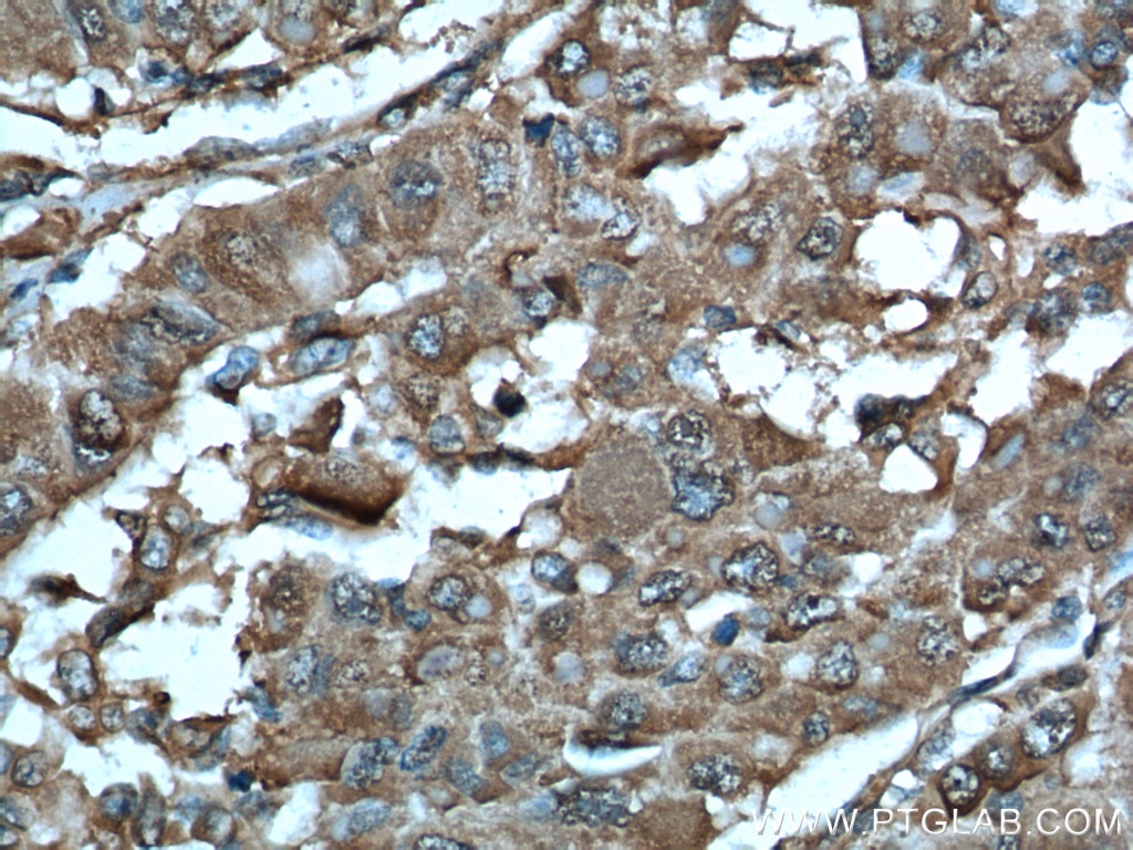 Immunohistochemistry (IHC) staining of human liver cancer tissue using MDH1 Polyclonal antibody (15904-1-AP)