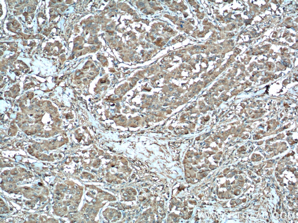 Immunohistochemistry (IHC) staining of human liver cancer tissue using MDH1 Polyclonal antibody (15904-1-AP)