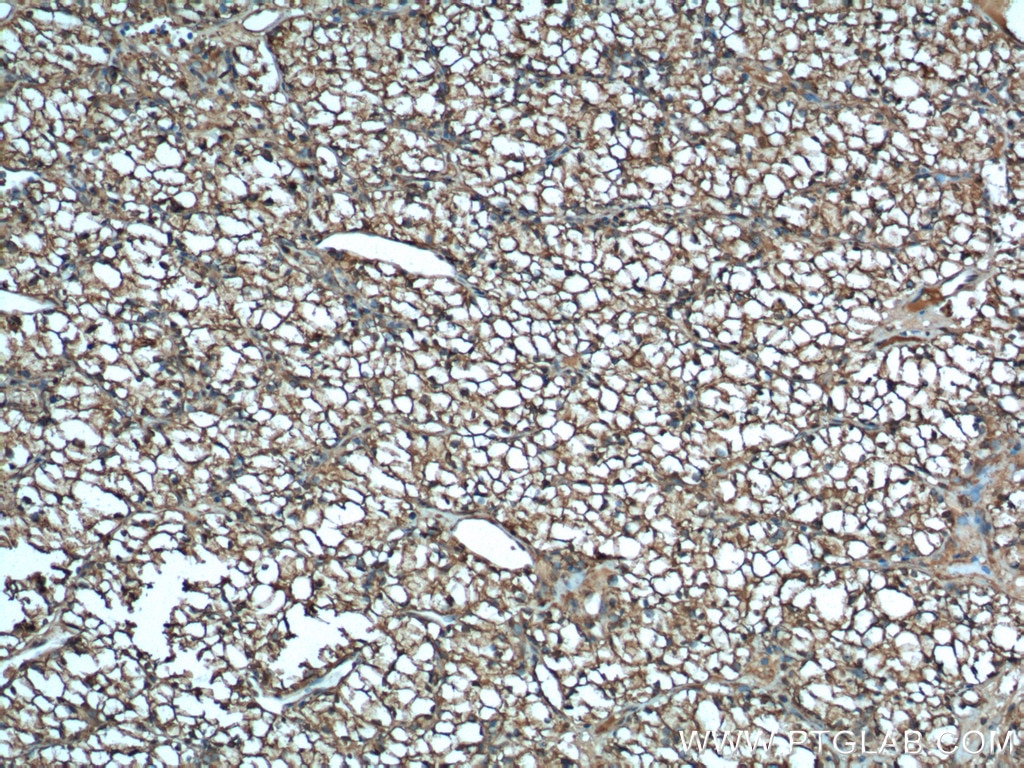 Immunohistochemistry (IHC) staining of human renal cell carcinoma tissue using MDH1 Polyclonal antibody (15904-1-AP)