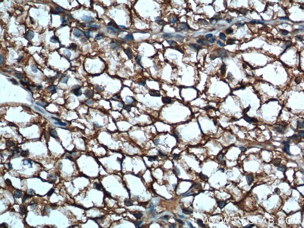 Immunohistochemistry (IHC) staining of human renal cell carcinoma tissue using MDH1 Polyclonal antibody (15904-1-AP)