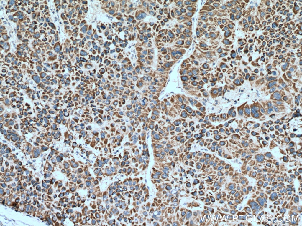 Immunohistochemistry (IHC) staining of human liver cancer tissue using MDH2 Polyclonal antibody (15462-1-AP)