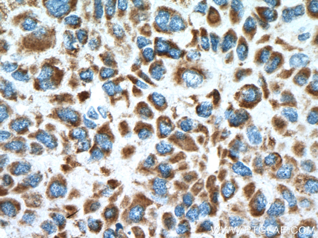 Immunohistochemistry (IHC) staining of human liver cancer tissue using MDH2 Polyclonal antibody (15462-1-AP)