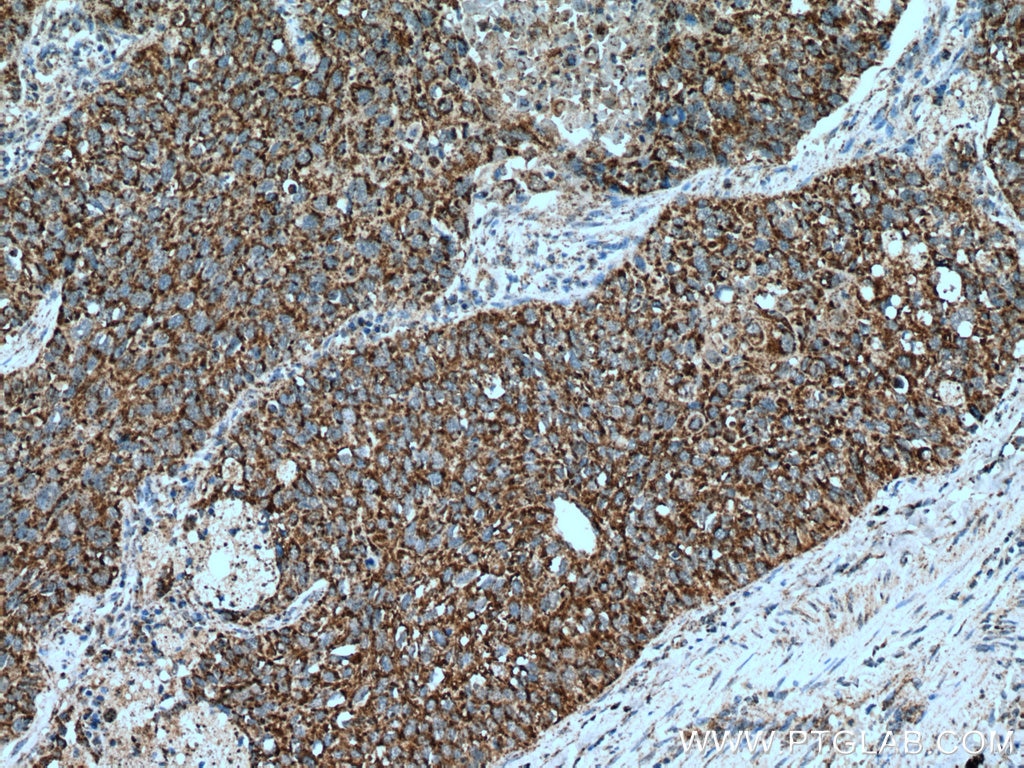 Immunohistochemistry (IHC) staining of human lung cancer tissue using MDH2 Polyclonal antibody (15462-1-AP)