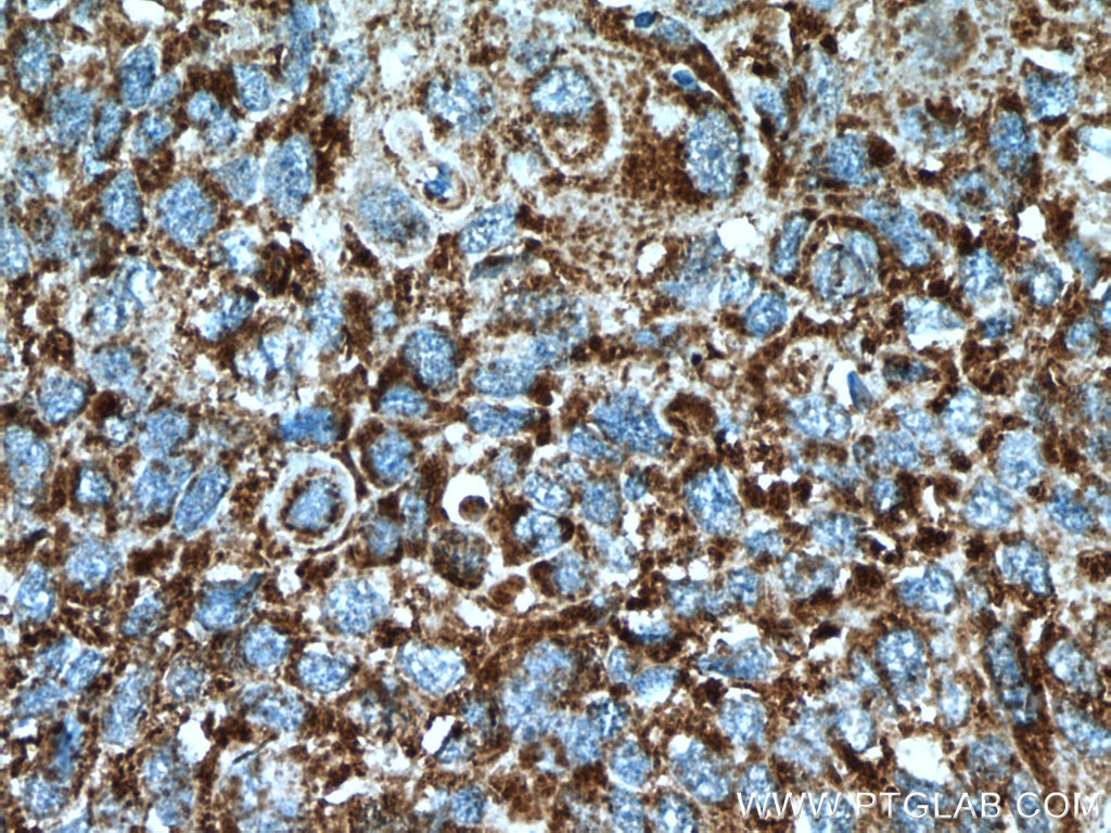Immunohistochemistry (IHC) staining of human lung cancer tissue using MDH2 Polyclonal antibody (15462-1-AP)
