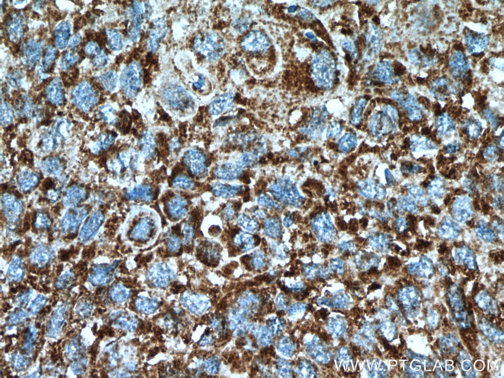 IHC staining of human lung cancer using 15462-1-AP