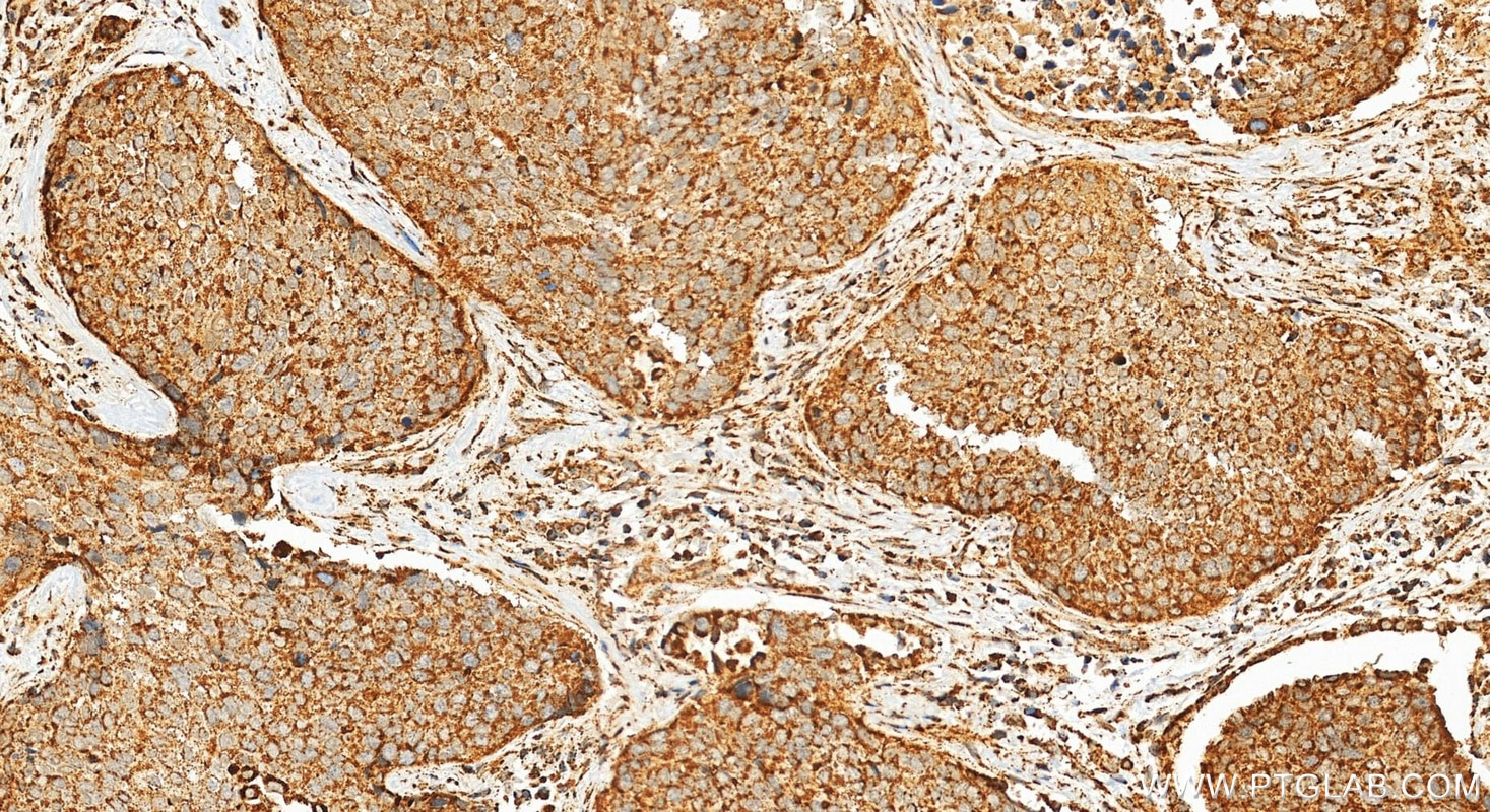 Immunohistochemical analysis of paraffin-embedded human lung cancer tissue slide using 15462-1-AP (MDH2 antibody) at dilution of 1:1000 (under 20x lens). Heat mediated antigen retrieval with Tris-EDTA buffer (pH 9.0). Immunohistochemistry (IHC) staining of human lung cancer tissue using MDH2 Polyclonal antibody (15462-1-AP)