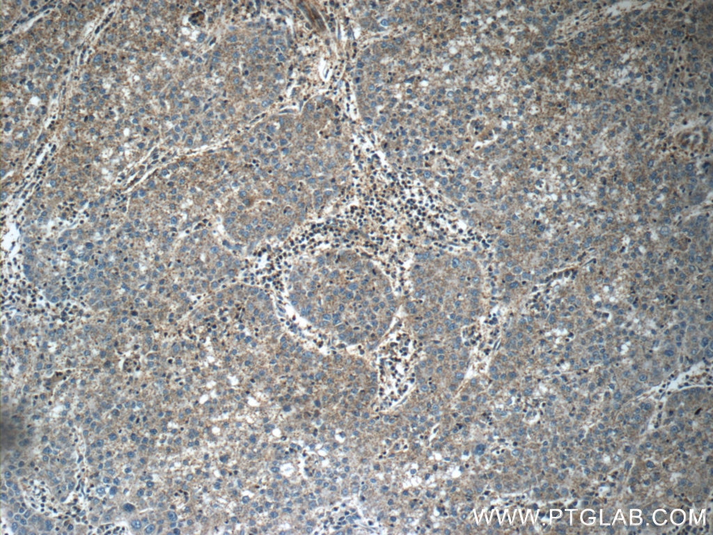 Immunohistochemistry (IHC) staining of human liver cancer tissue using Midkine Polyclonal antibody (11009-1-AP)