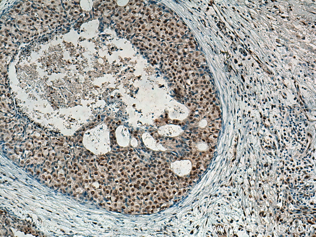 Immunohistochemistry (IHC) staining of human breast cancer tissue using MDM2 Monoclonal antibody (66511-1-Ig)