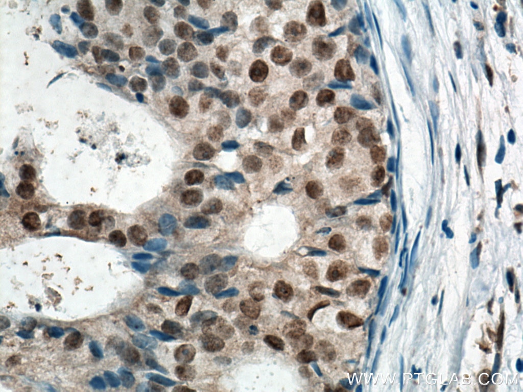 Immunohistochemistry (IHC) staining of human breast cancer tissue using MDM2 Monoclonal antibody (66511-1-Ig)