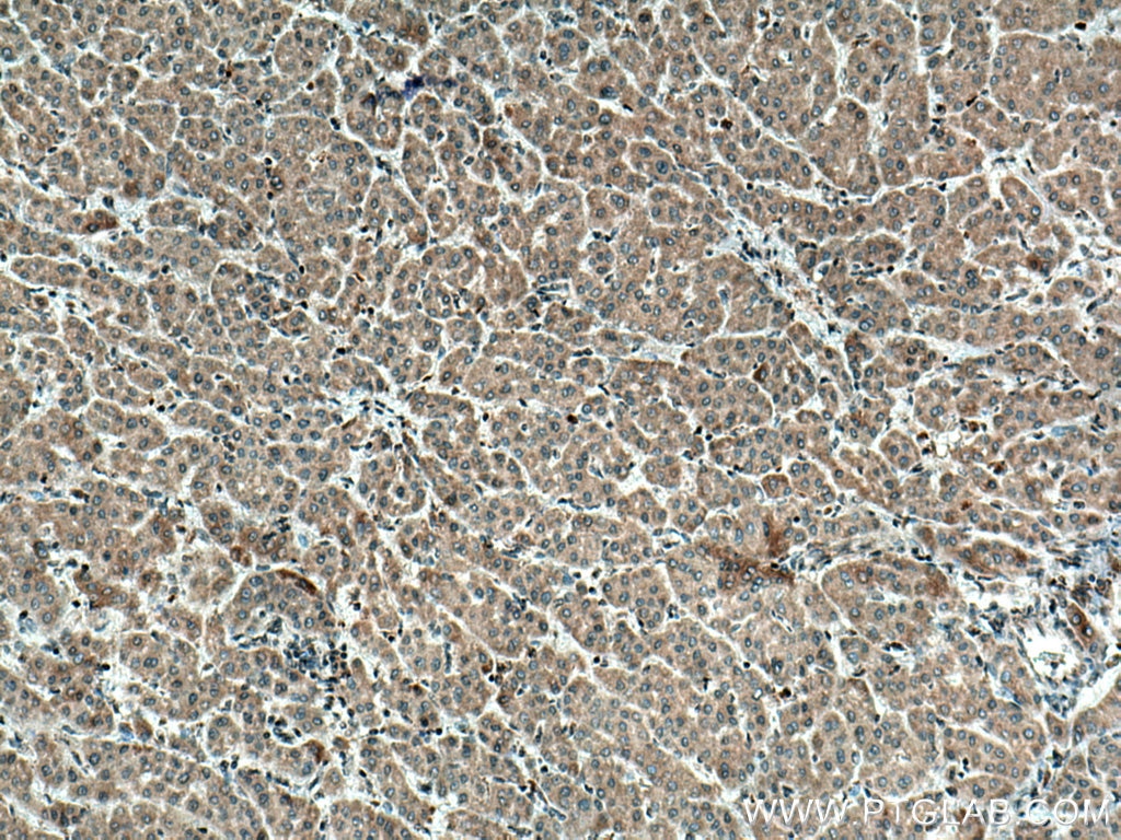 IHC staining of human liver cancer using 66511-1-Ig