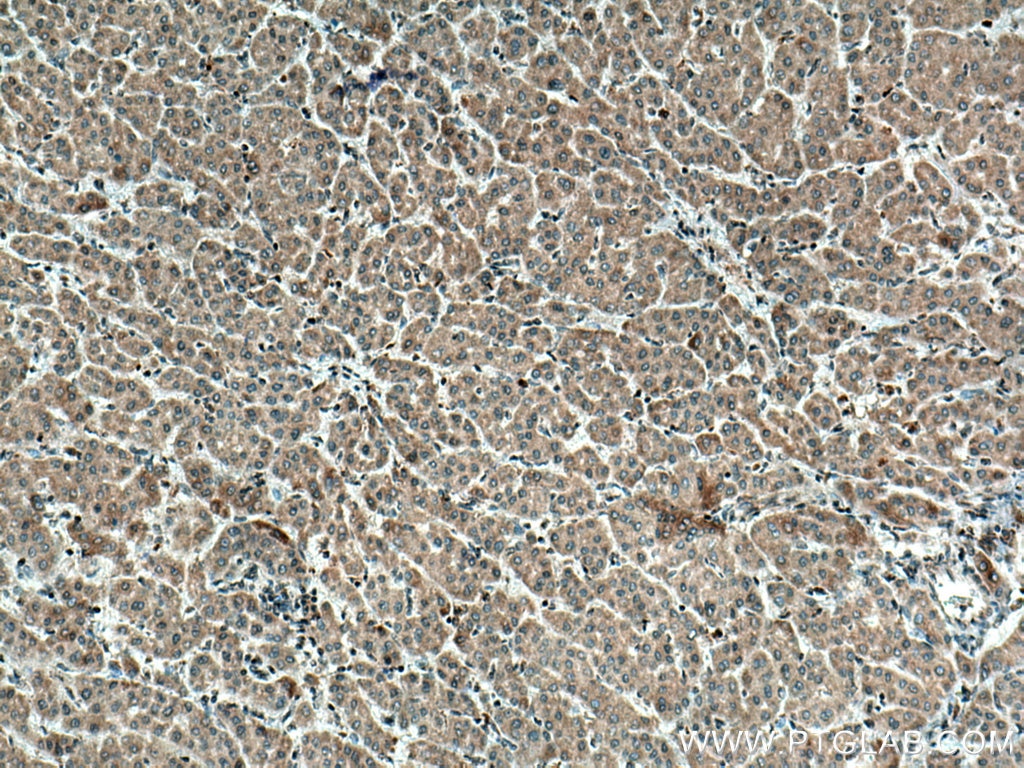 Immunohistochemistry (IHC) staining of human liver cancer tissue using MDM2 Monoclonal antibody (66511-1-Ig)