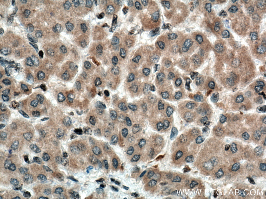Immunohistochemistry (IHC) staining of human liver cancer tissue using MDM2 Monoclonal antibody (66511-1-Ig)