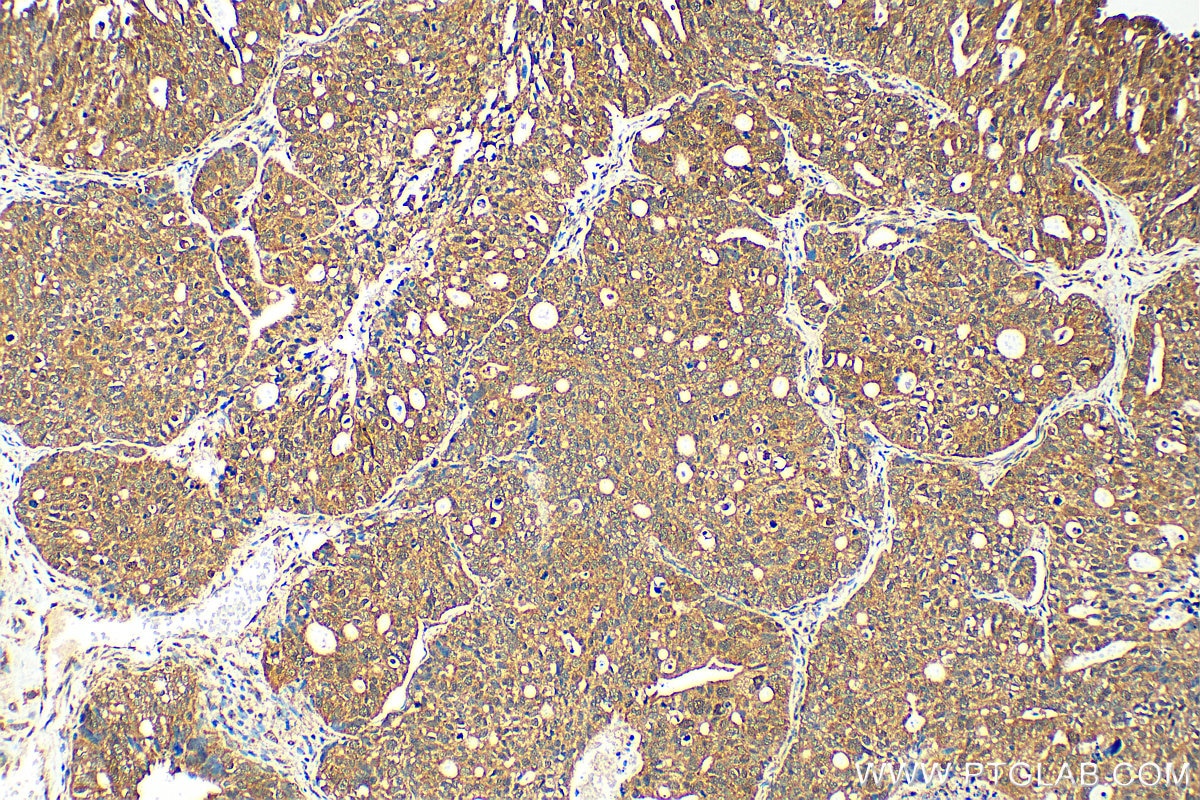 Immunohistochemistry (IHC) staining of human ovary tumor tissue using MDMX Polyclonal antibody (17914-1-AP)